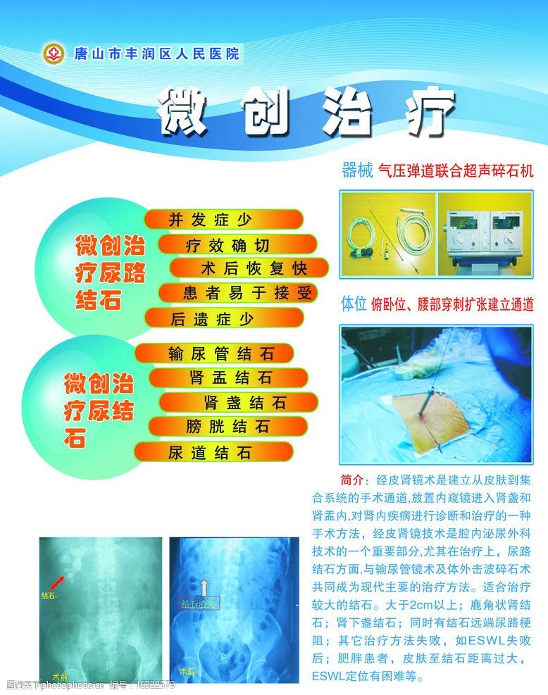 结石微创治疗图片
